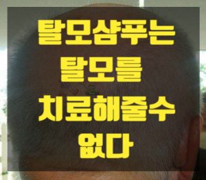 탈모예방 썸네일이미지